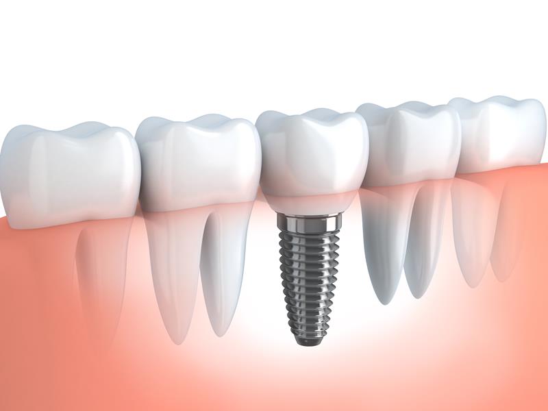 Dental Implants Lynden, WA