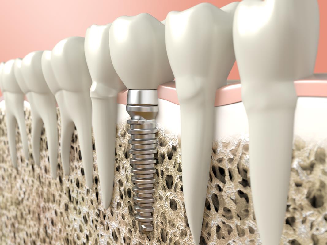 Dental Implants  Lynden, WA 