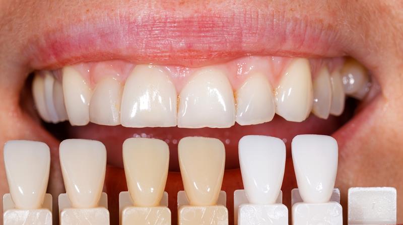 Veneers Lynden, WA